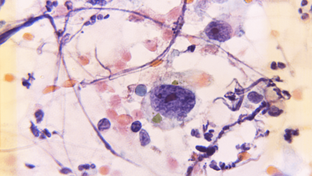 Signs and Symptoms of Cancer